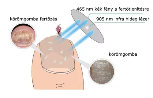 MediLaser Lézeres körömgomba kezelő készülék lábujjakra