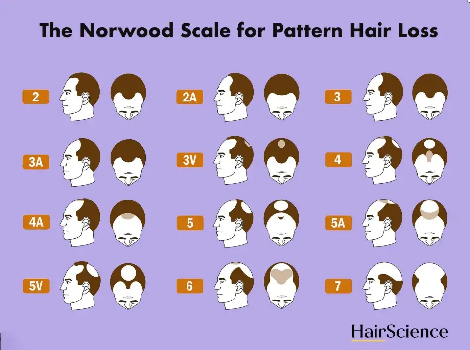 Norwood–Hamilton skála – férfi mintázatú hajhullás