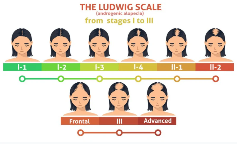Ludwig–Savin skála – női hajritkulás